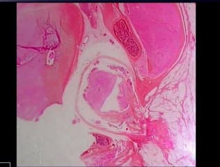 Lipomyeloméningocele