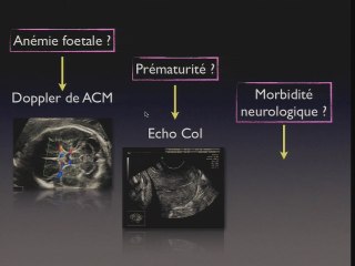 Mort foetale d'un des deux jumeaux - Intérêt échographique