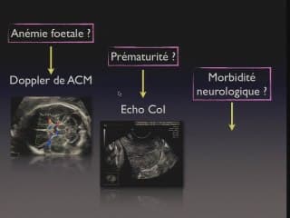Mort foetale d'un des deux jumeaux - Intérêt échographique
