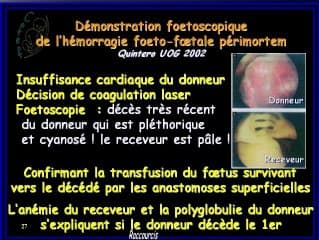 Syndrome transfuseur-transfusé : hémodynamique