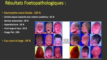 Phénotype foetal associé aux mutations PTPN11, RIT1, RAF1 et NRAS dans le syndrome de Noonan : signes échographiques, fœtopathologie et revue de la littérature
