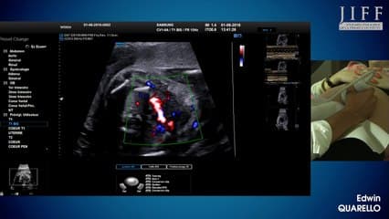 atelier : le coeur foetal