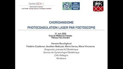 Photocoagulation laser par foetoscopie en cas de Chorioangiome
