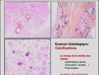 Foetopathologie et anasarque