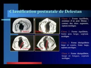 Diagnostic échographique anténatal des fentes labio-palatines unilatérales. Etude de concordance anatomique et valeur pronostic postnatal de l'examen échographique en mode volumique