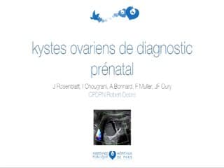 Kystes ovariens de diagnostic prénatal