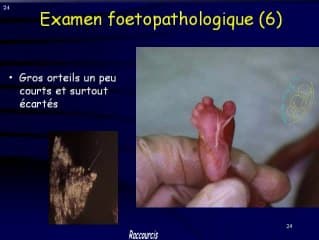 Nanisme microcéphalique ostéodysplastique primordiale de type 2