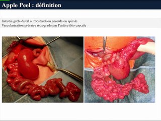 Apple-Peel et atrésies multiples : pourquoi n’y arrive t’on pas ?