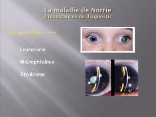Un cas de diagnostic prénatal de maladie de Norrie