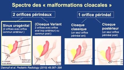 Le sinus uro-génital : un diagnostic difficile