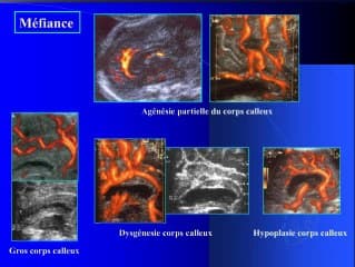 Cerveau : les confrontations pré et postnatales