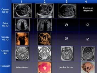 Le diagnostic foetal du syndrome de Joubert : c'est possible.