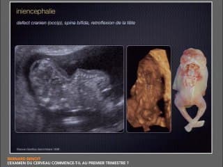 L'examen du cerveau commence-t-il au premier trimestre ?