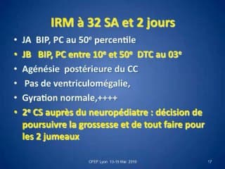 agénésie partielle corps calleux gemellaire