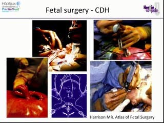 Un point sur la chirurgie in utero (vidéo).