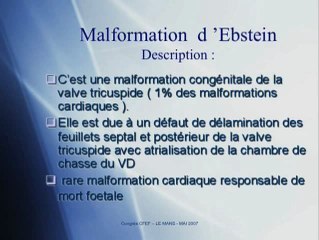 Maladie d'Ebstein