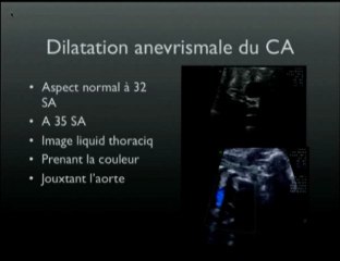 Anévrysme du canal artériel