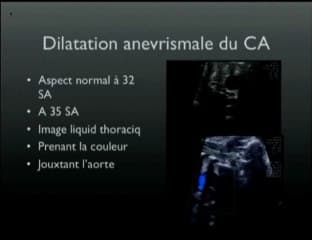 Anévrysme du canal artériel