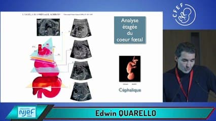 Variantes de la normale en échographie cardiaque foetale