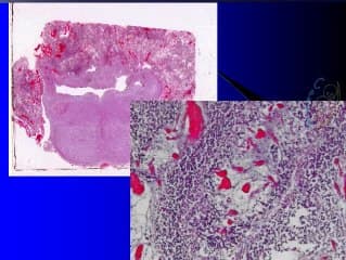 Dysplasie du cervelet