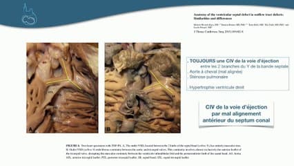 CŒUR ET VAISSEAUX Le spectre de la tétralogie de Fallot