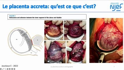 Le placenta accreta en échographie