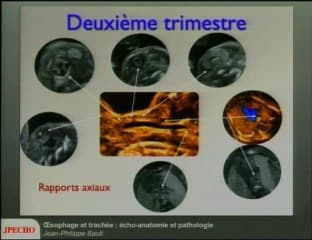 Oesophage et trachée : écho-anatomie et pathologie