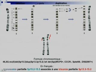 Points calcanéens échogènes à 12 SA