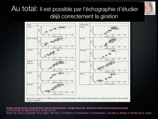 5 Pathologies du cerveau foetal trouble de gyration