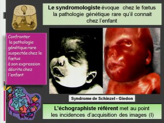 Anomalies de la face foetale : le généticien peut-il aider ?