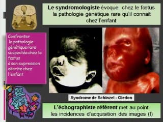 Anomalies de la face foetale : le généticien peut-il aider ?