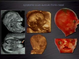 Écho-analyse de la face embryonnaire entre 8 SA et 13 SA.