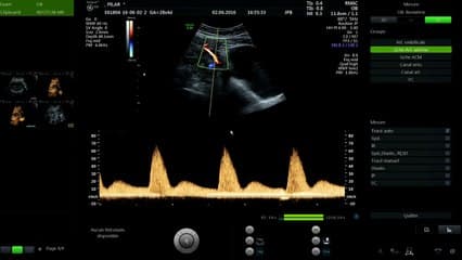 Live  la surveillance du RCIU