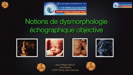 Dysmorphologie échographique