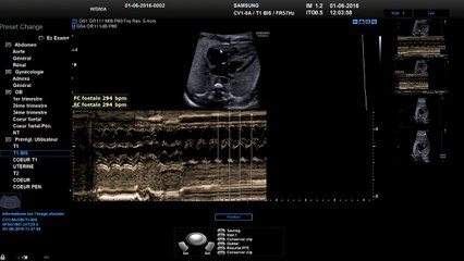 Troubles du rythme cardiaque Comment caractériser les troubles du rythme cardiaque (2D, doppler, TM)