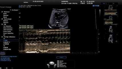 Troubles du rythme cardiaque Comment caractériser les troubles du rythme cardiaque (2D, doppler, TM)