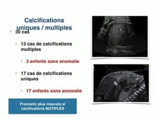 Calcifications hépatiques foetales : à propos de 30 cas de diagnostic anténatal.