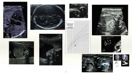 Le dépistage des anomalies échographiques à l'aune des nouvelles technologies : que reste-t-il des signes mineurs en échographie au deuxième  et troisième trimestre de la grossesse ?