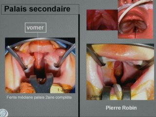 La triade de Robin