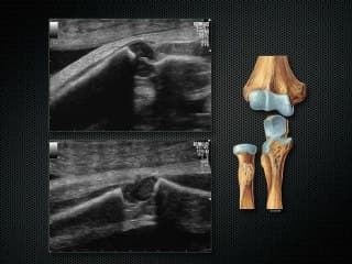 Aspect normal des os longs foetaux en échographie