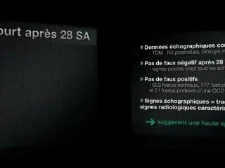 L’achondroplasie : une échographie et rien d’autre ?