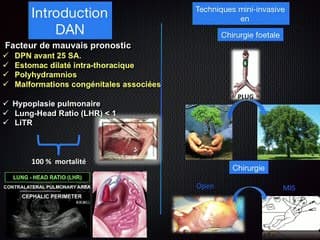 Place de la thoracoscopie dans le traitement desHernies de coupoles diaphragmatiques