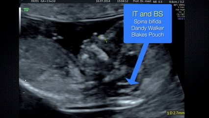 Une autre façon de regarder le foetus au 1er trimestre la face
