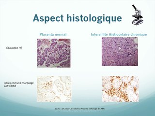 Intervillite histiocytaire chronique : étude observationnelle sur 20 ans et revue de la littérature.