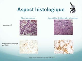 Intervillite histiocytaire chronique : étude observationnelle sur 20 ans et revue de la littérature.