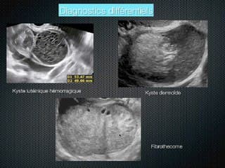 Endométriose : échographie