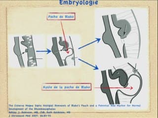 La clarté intra-cérébrale au 1er trimestre: un diagnostic inattendu