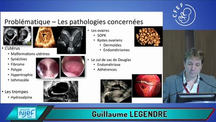 La place de l’échographie dans le bilan d’infertilité : nouvelles recommandations du CNGOF
