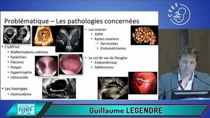 La place de l’échographie dans le bilan d’infertilité : nouvelles recommandations du CNGOF