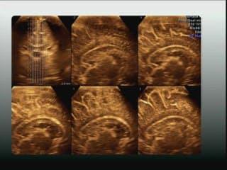 Un corps calleux pas comme les autres